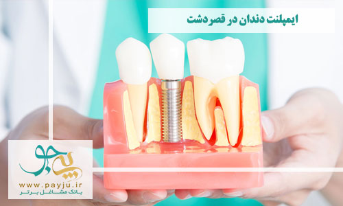 ایمپلنت دندان در قصردشت شیراز