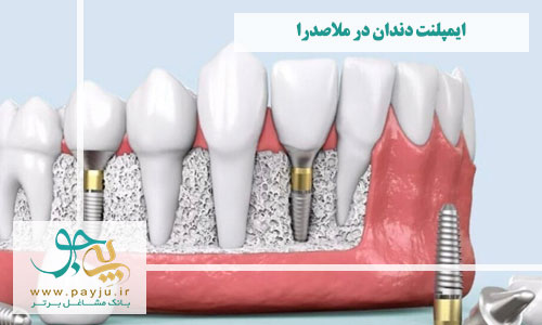 دندانپزشکان ایمپلنت دندان در ملاصدرا شیراز