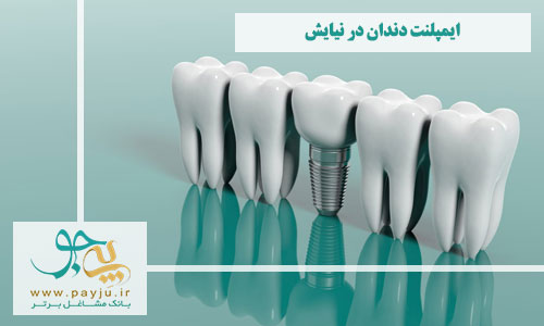 بهترین دندانپزشک ایمپلنت دندان در نیایش شیراز