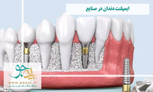 بهترین دندانپزشکان ایمپلنت دندان در صنایع شیراز