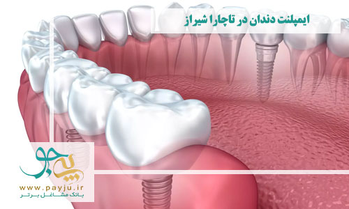 لیست بهترین دندانپزشکان ایمپلنت دندان در تاچارا شیراز