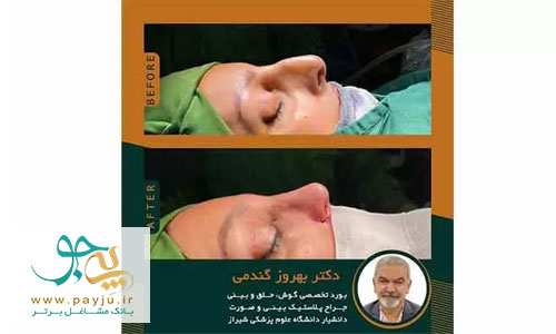 بهترین جراح بینی استخوانی در شیراز