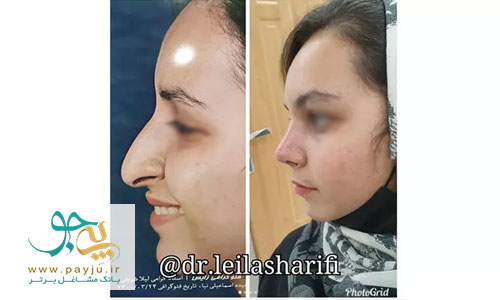 بهترین جراح بینی استخوانی در شیراز