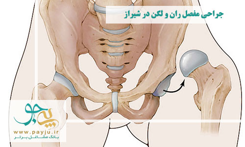 پزشکان فوق تخصص جراحی مفصل ران و لگن در شیراز