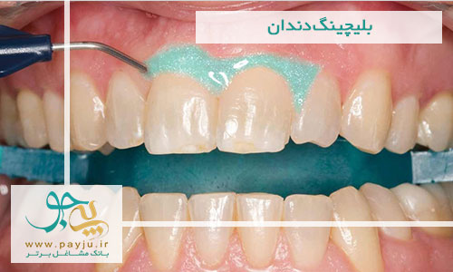دردهای ناشی از سفید کردن دندان - بلیچینگ دندان