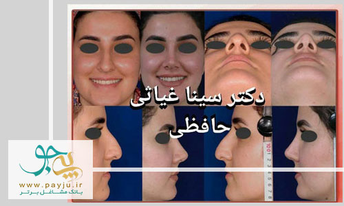 نمونه کار دکتر غیاثی جراح پلاستیک بینی در شیراز