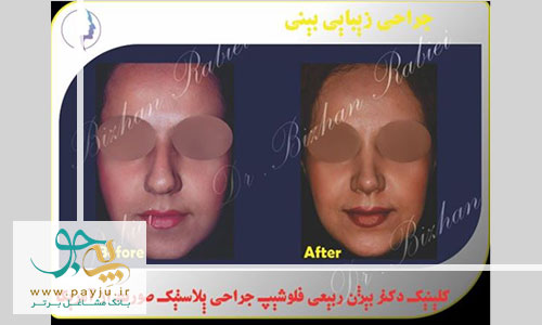 نمونه کار دکتر ربیعی جراح عمل بینی در شیراز