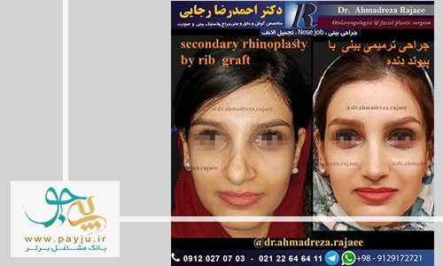 نمونه کار دکتر رجایی جراحی بینی در شیراز