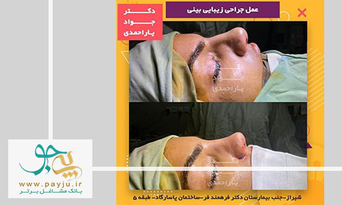 نمونه کار دکتر یاراحمدی جراح بینی در شیراز