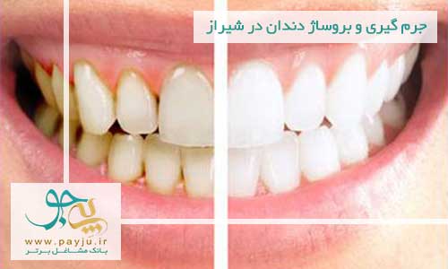دندانپزشکان متخصص جرم گیری و بروساژ دندان در شیراز