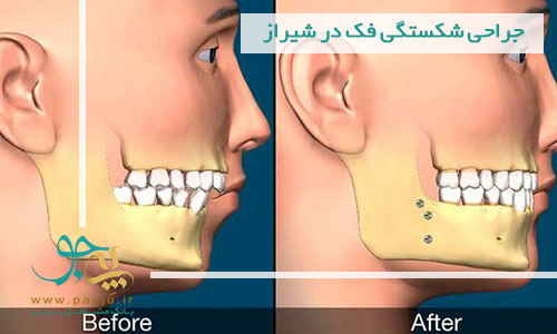جراحی شکستگی فک در شیراز