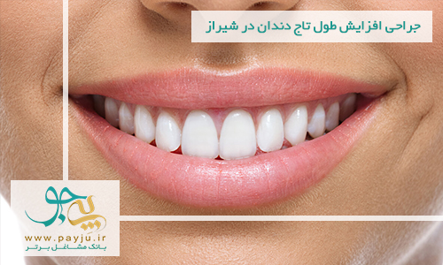 جراحی افزایش طول تاج دندان در شیراز