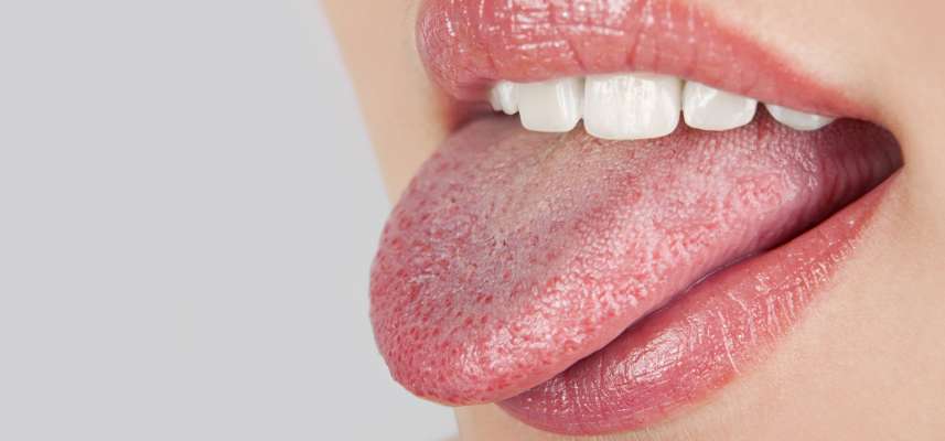 سندرم خشکی دهان چیست و راه های درمان آن کدامند؟