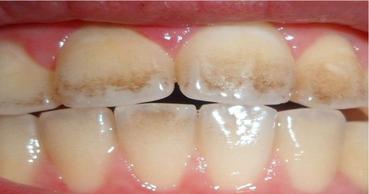 علت ایجاد لکه های قهوه ای روی دندان ها چیست؟