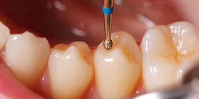 پر کردن دندان با کامپوزیت بهتر است یا آمالگام؟