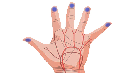 علت بی حسی انگشتان دست چیست؟