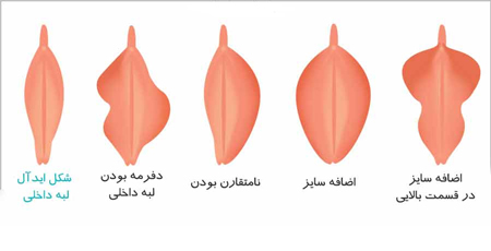 ساختار درون واژن و آشنایی با اشکال مختلف واژن