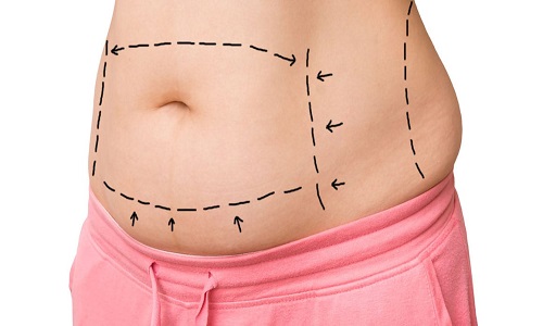 عوارض جراحی کوچک کردن شکم ابدومینوپلاستی لیپوماتیک