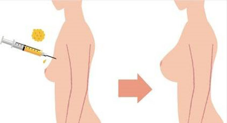 تزریق چربی به سینه چگونه انجام می شود؟