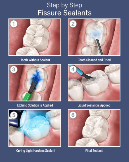 فیشور سیلانت چیست و چه فوایدی برای دندان ها دارد؟