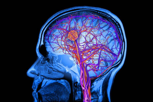  تفاوت آنوریسم مغزی و سکته مغزی چیست؟