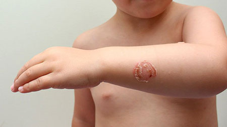 علائم و درمان بیماری زرد زخم در کودکان چیست؟