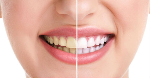آیا جرم گیری دندان ها کار درستی است؟