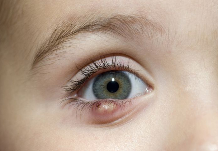 علائم و روش های درمان شالازیون چشم چیست؟