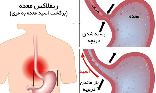 علائم، پیشگیری و روش درمان رفلاکس چیست؟ علائم، پیشگیری و روش درمان رفلاکس چیست؟