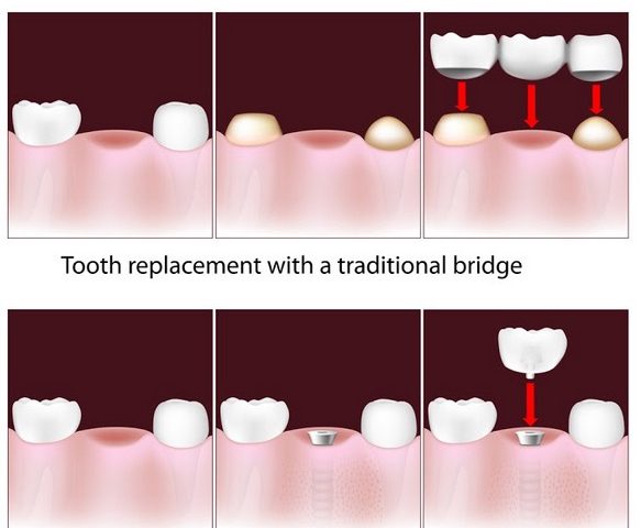 مقایسه بریج و ایمپلنت برای جایگزینی دندان های از دست رفته