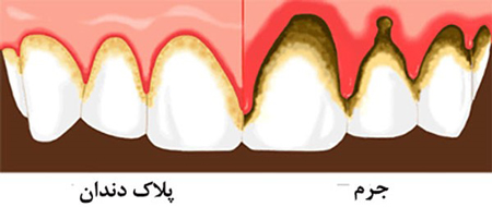فواید انجام بروساژ دندان چیست؟