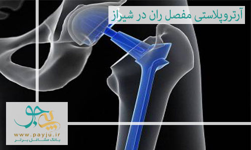 آرتروپلاستی مفصل ران در شیراز