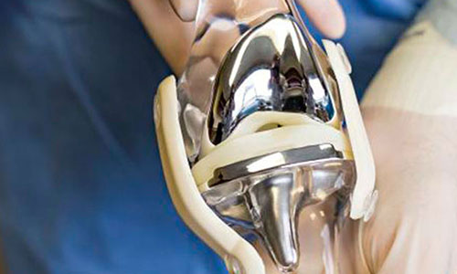جراحی تعویض مفصل زانو یا آرتروپلاستی چیست؟