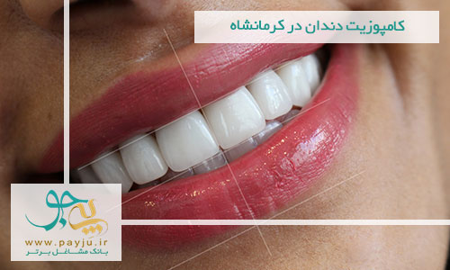 کامپوزیت دندان در کرمانشاه