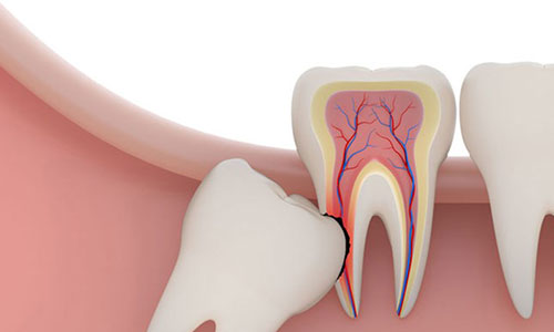 دندان عقل چیست و در کدام قسمت دهان قراردارد؟