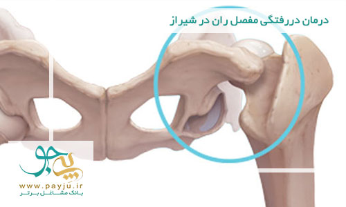 درمان دررفتگی مفصل ران در شیراز