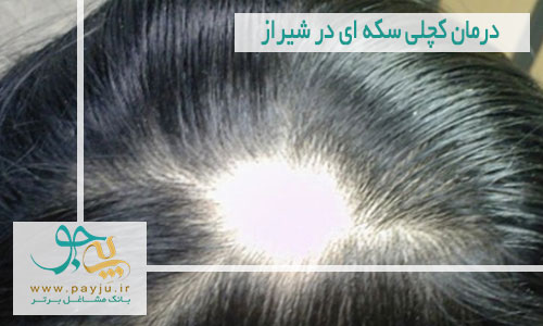 درمان کچلی سکه ای در شیراز