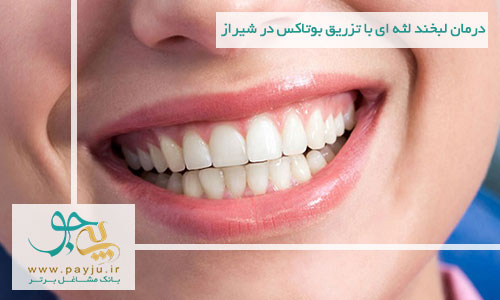 درمان لبخند لثه ای با تزریق بوتاکس در شیراز