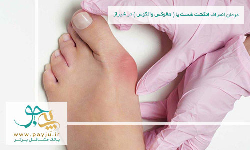 درمان انحراف انگشت شست پا ( هالوکس والگوس ) در شیراز
