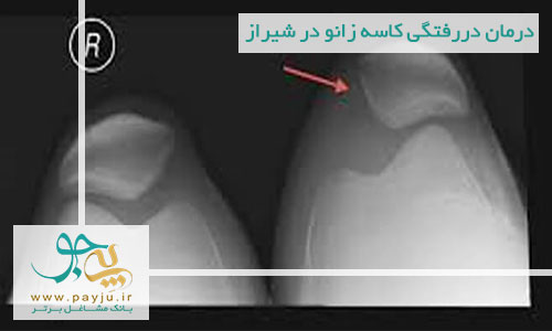 درمان دررفتگی کاسه زانو در شیراز