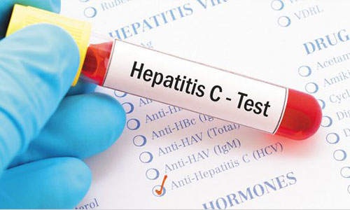 هپاتیت سی به همراه علائم و نشانه های آن