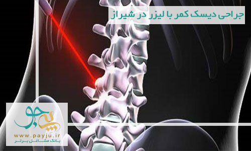 عمل جراحی دیسک کمر با لیزر در شیراز
