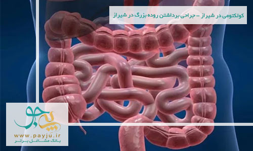 کولکتومی در شیراز - جراحی برداشتن روده بزرگ در شیراز