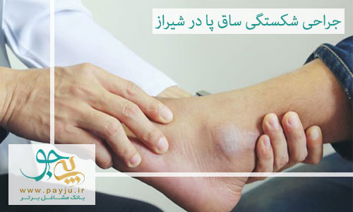 جراحی شکستگی ساق پا در شیراز
