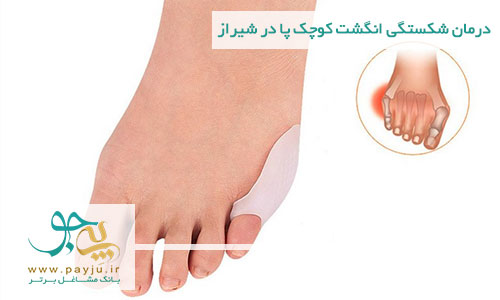 درمان شکستگی انگشت کوچک پا در شیراز