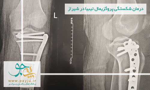 درمان شکستگی پروگزیمال تیبیا در شیراز