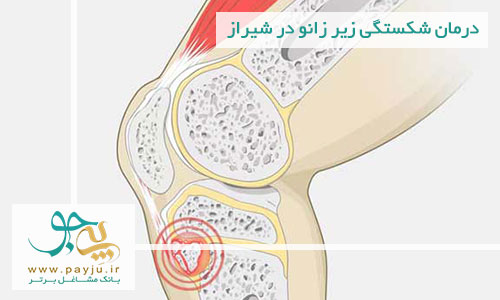 درمان شکستگی زیر زانو در شیراز