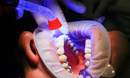 باکتری‌های دهانی به گسترش سرطان روده بزرگ کمک می‌کنند