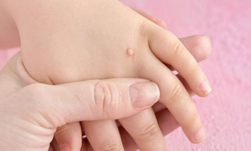 زگیل دست کودکان ، 4 سوال مهم در مورد آن