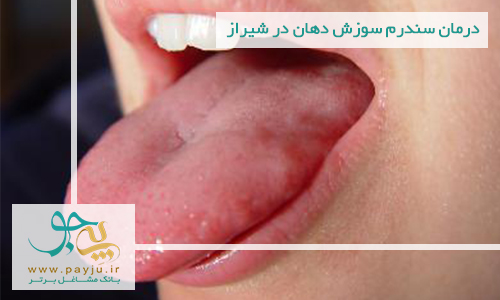 درمان سندرم سوزش دهان در شیراز